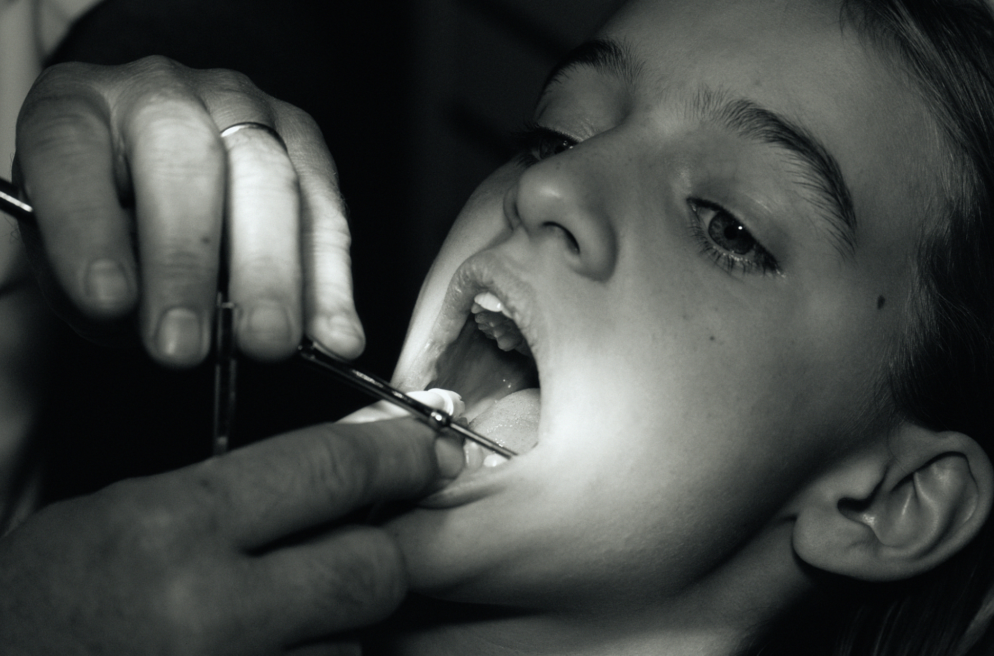 怎么判断口腔白斑有没有癌变?