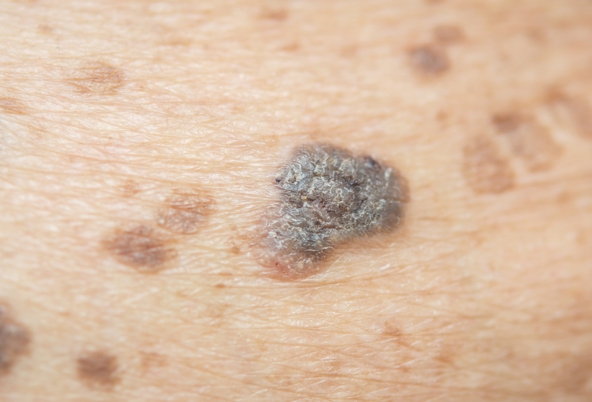 湖南长沙的一位大妈十几年的痣,突然变大,一检查果然是"它""!