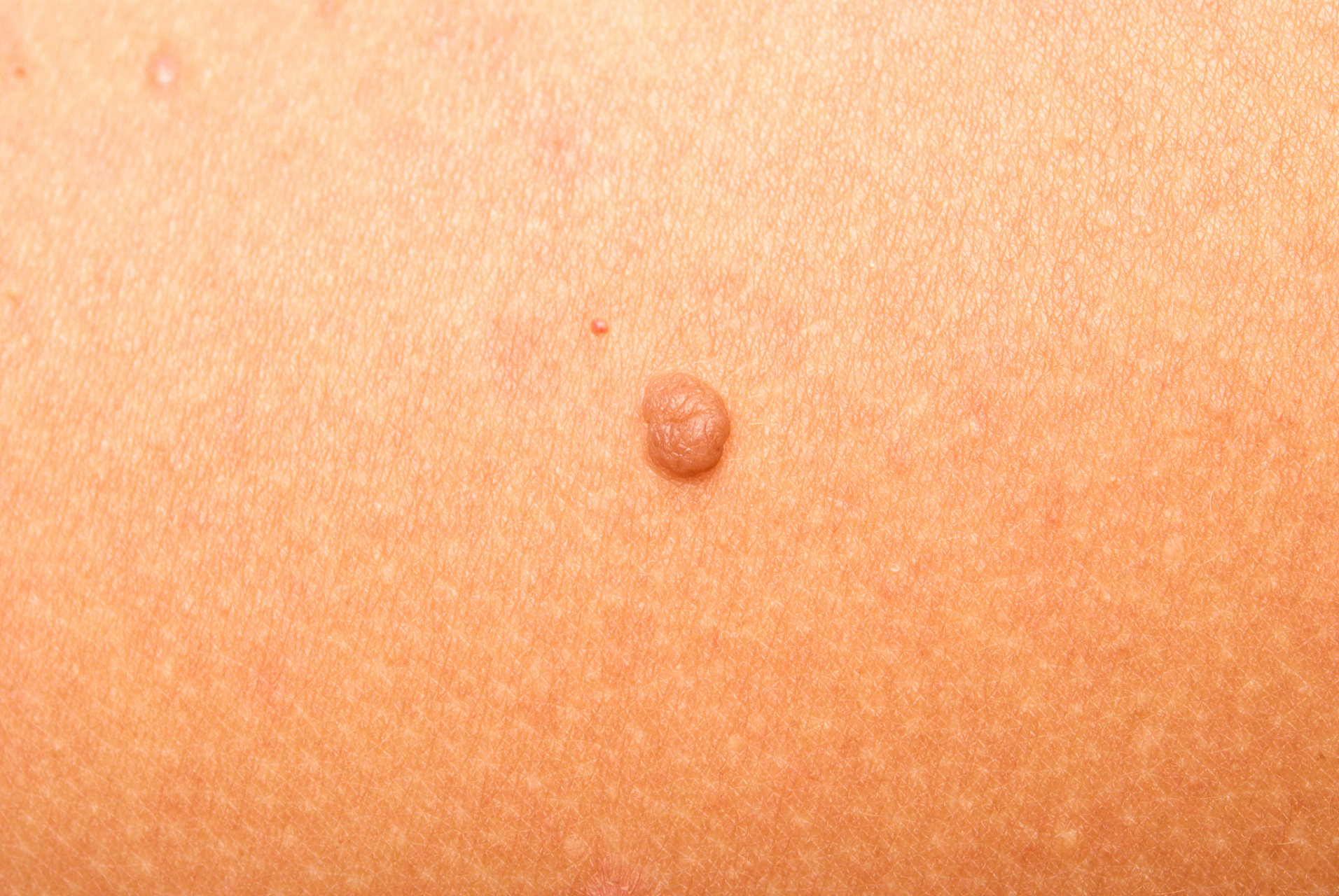 男孩去水上乐园玩水感染传染性软疣  近日,一名小男孩随家长到水上