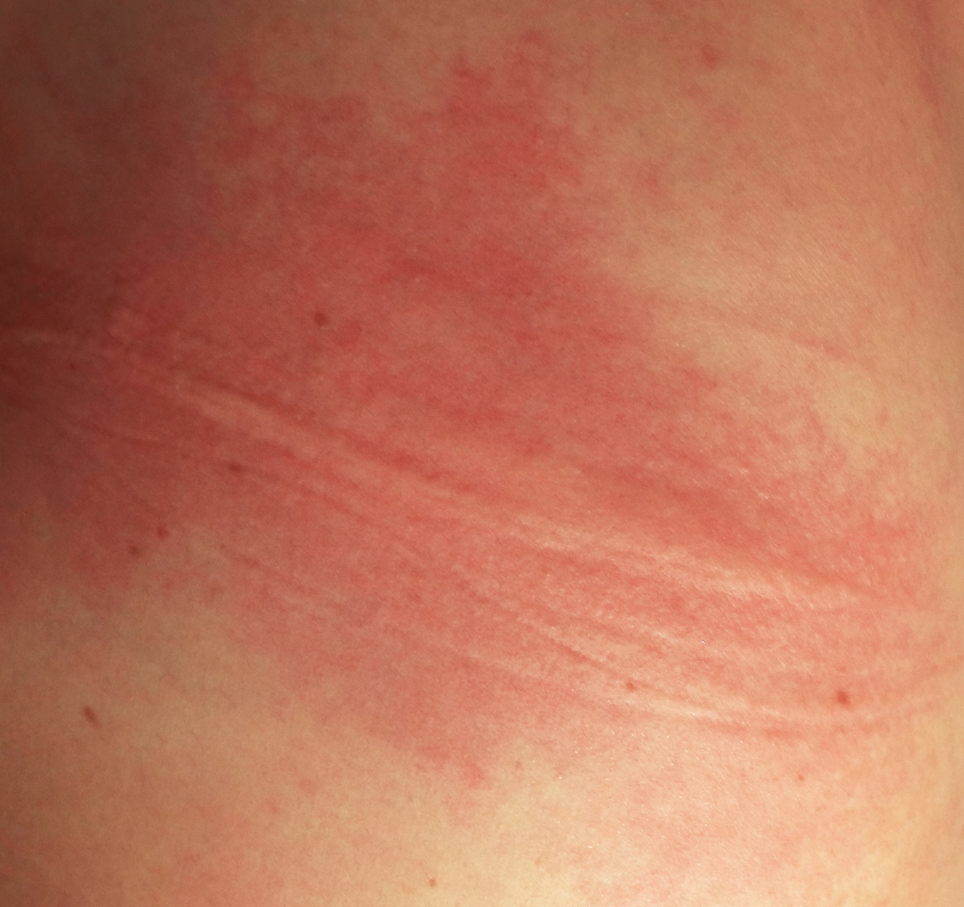 孩子为什么屁股会变红?