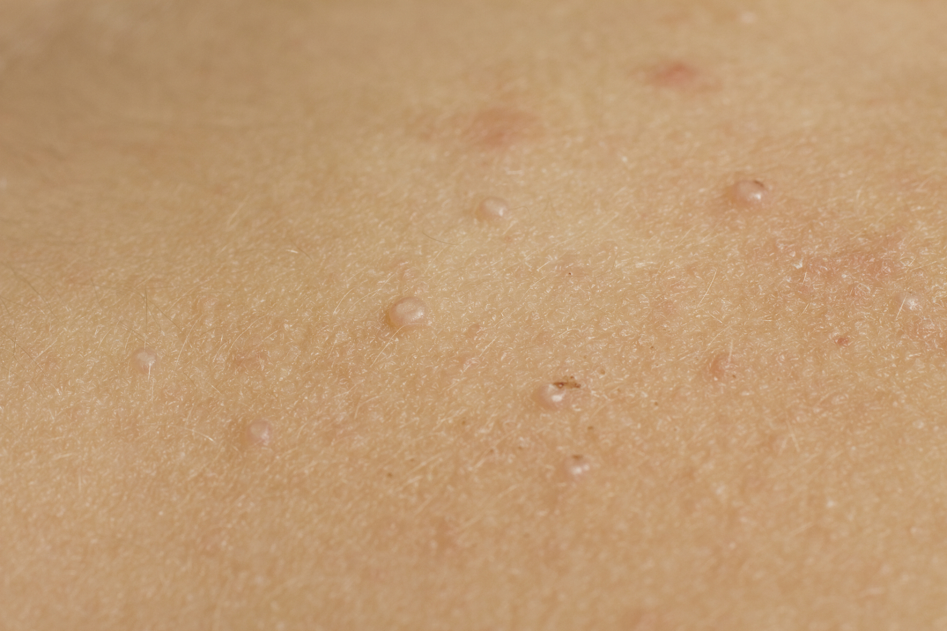 体癣是一种常见的皮肤癣,通常发生在身体的不同部位,如躯干,手臂和