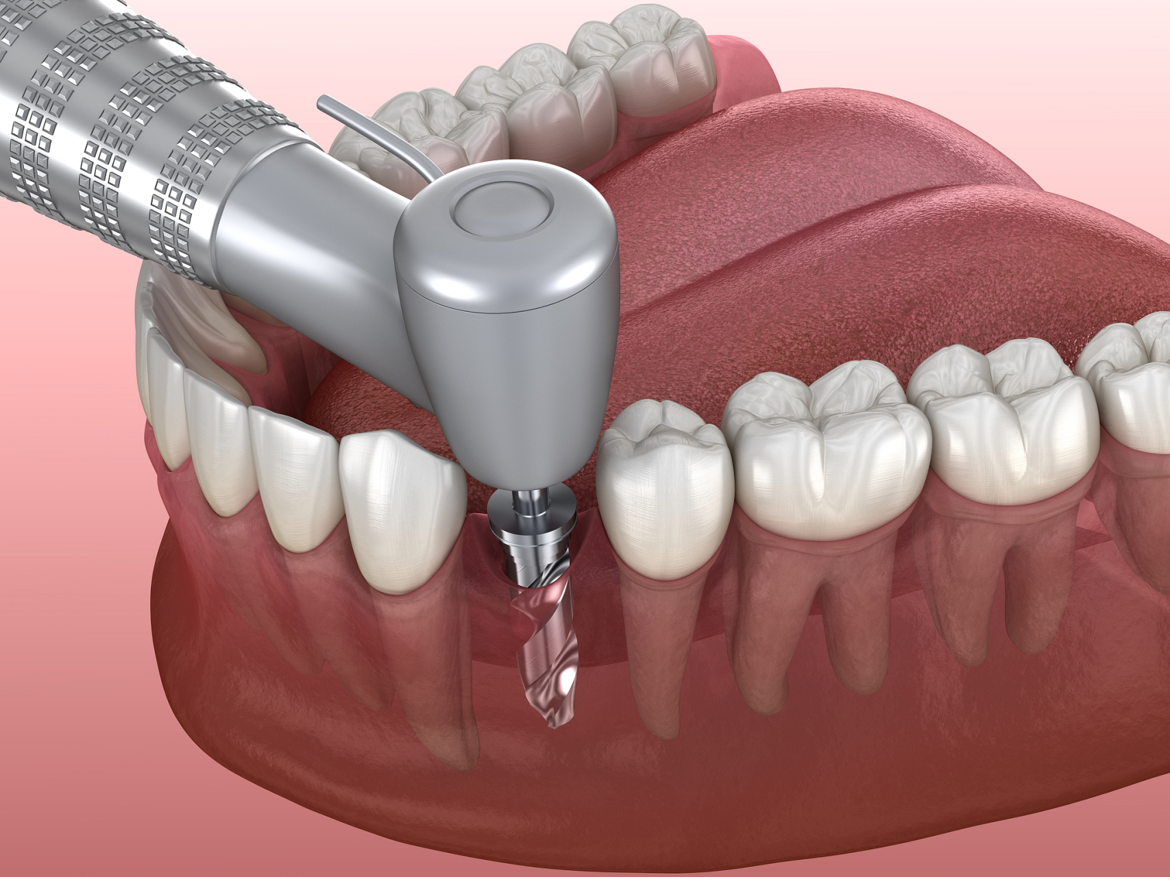 种植牙后,口腔卫生至关重要.
