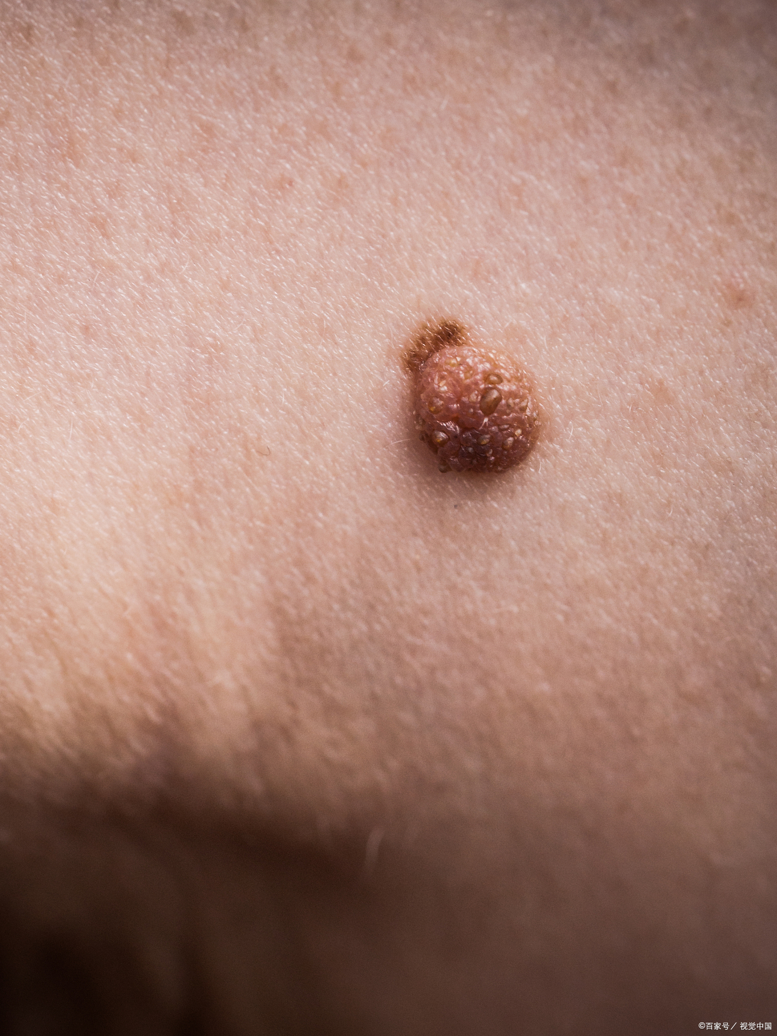 痣偶尔会痒正常吗  痣偶尔痒一下是正常的,但是如果长期,反复瘙痒