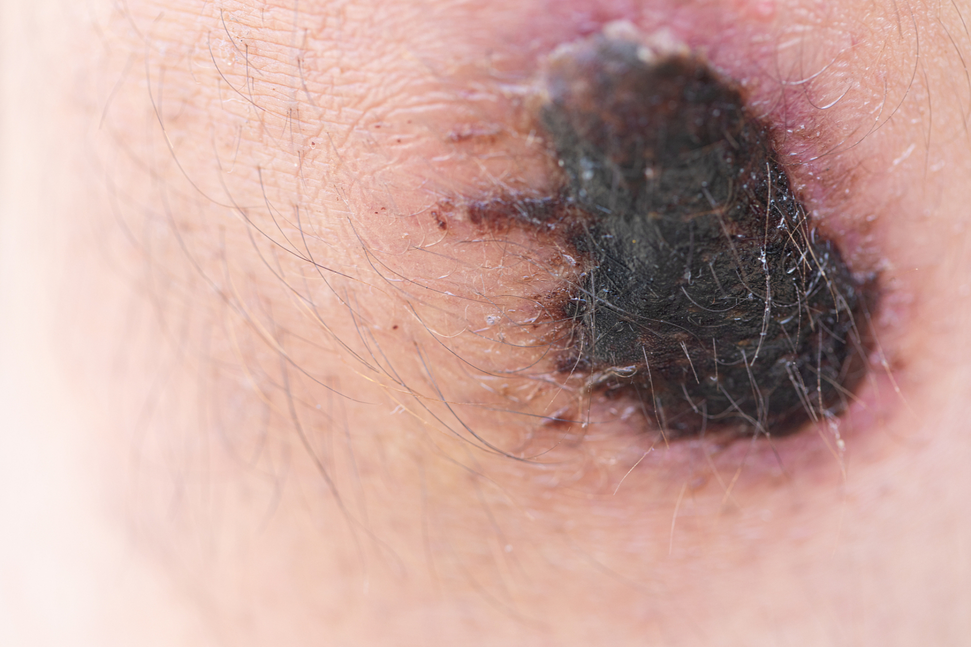 97 黑毛痣,别让小瑕疵阻挡你的美!