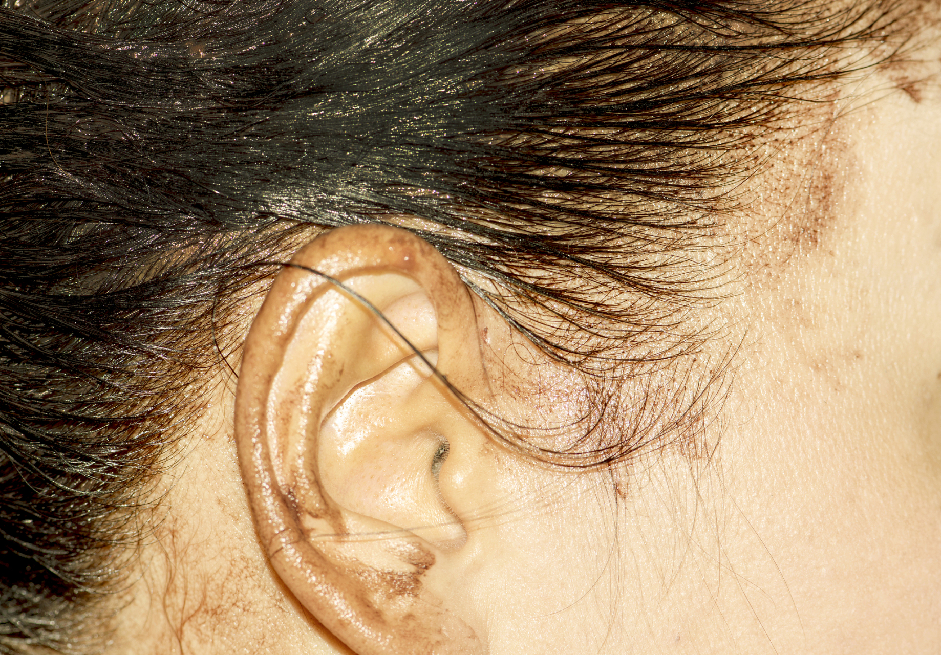 油耳指的是头皮过度分泌油脂,导致头皮油腻,油光满面的情况.