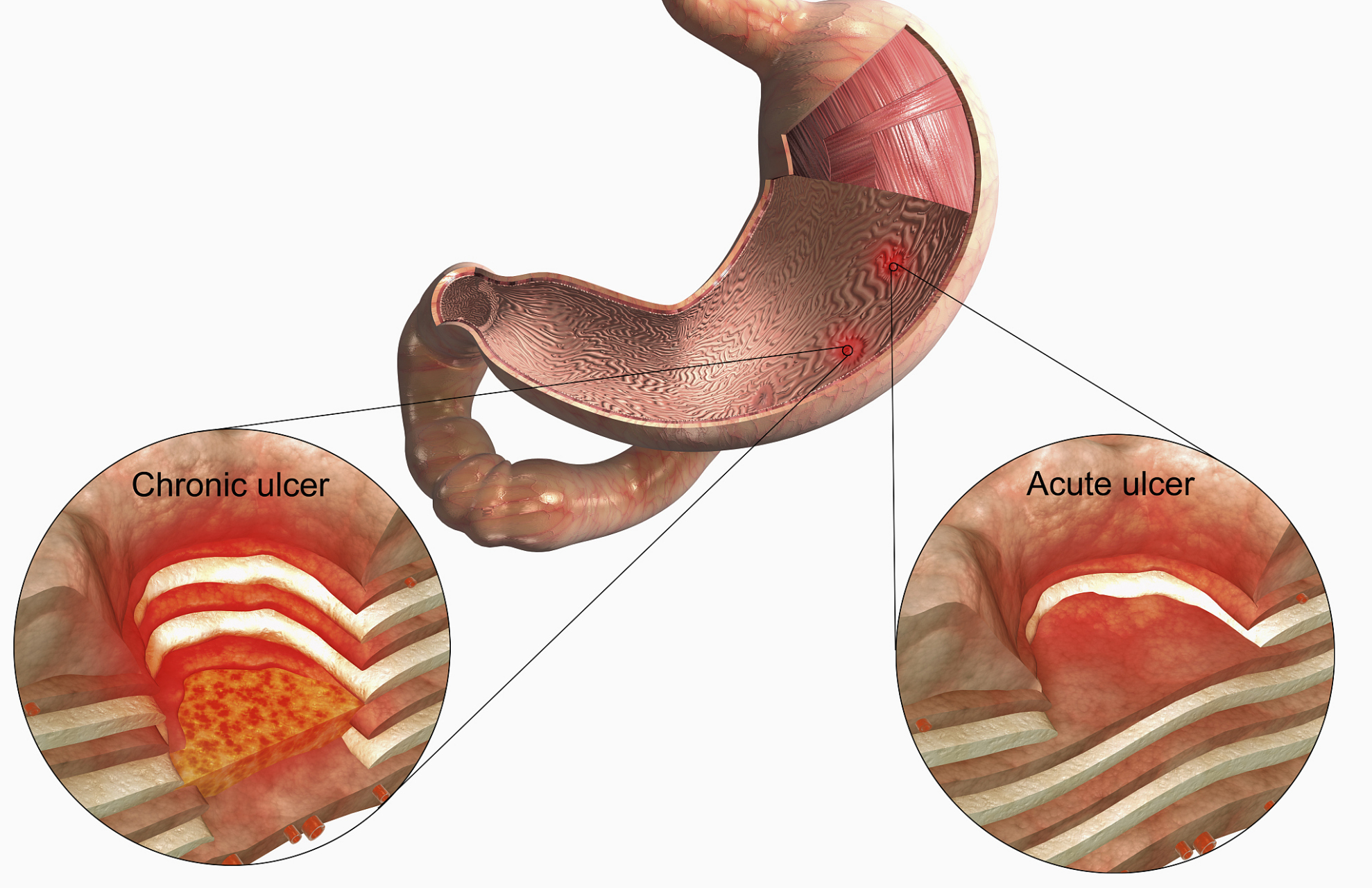了解消化道穿孔:症状,原因及治疗方法 消化道穿孔是