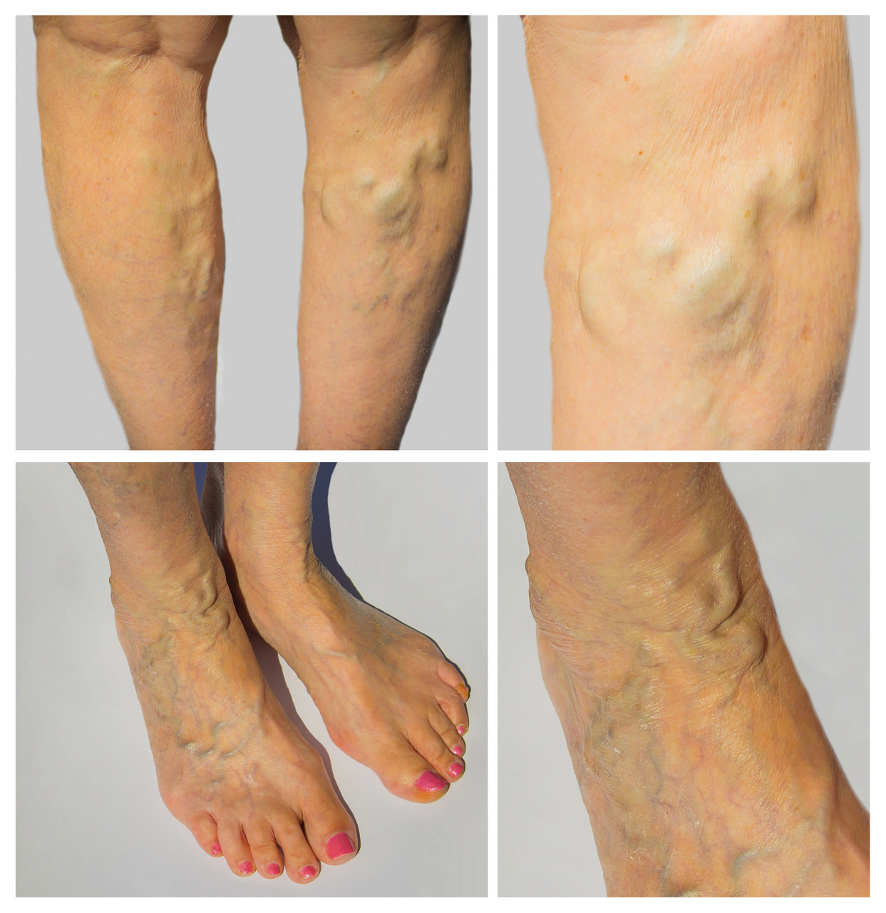 小腿静脉曲张这种常见的血管疾病能否根治呢?今天,一起揭开这个谜 ..