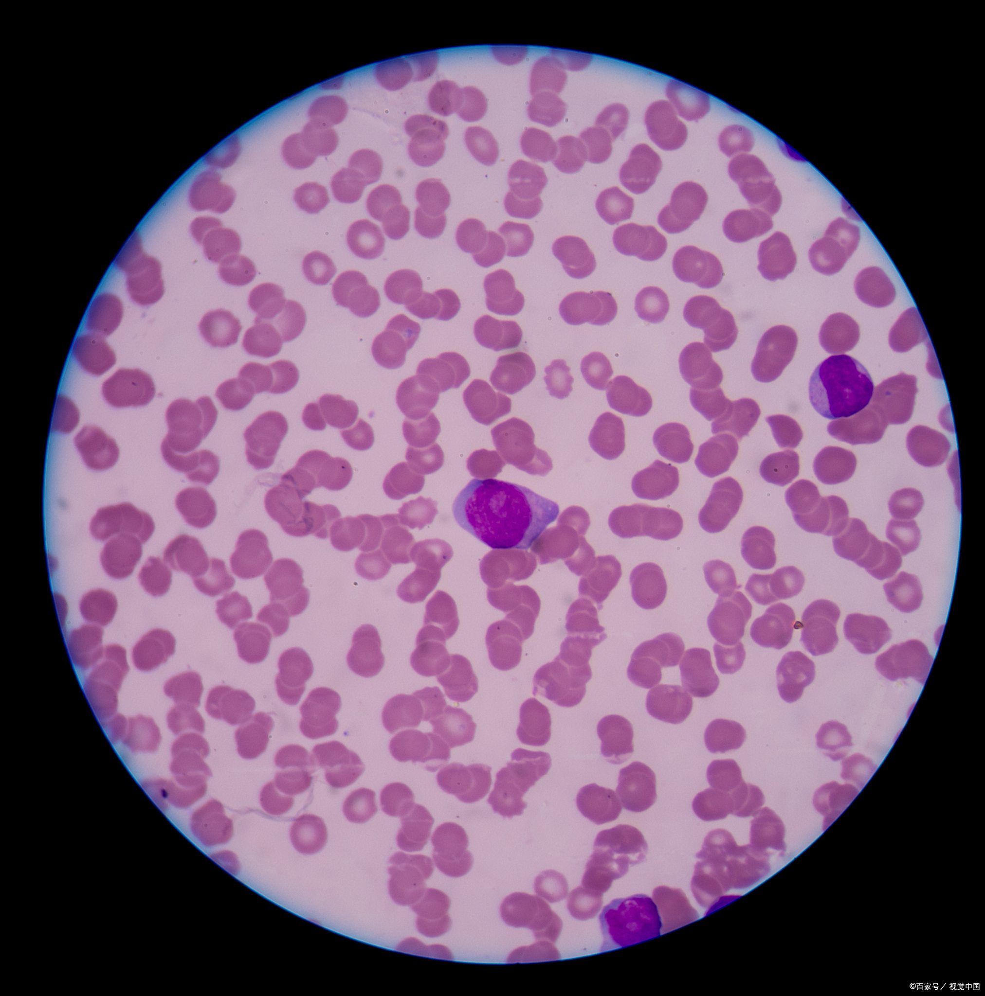 mds铁粒幼细胞贫血,"转白"风险到底有多大?