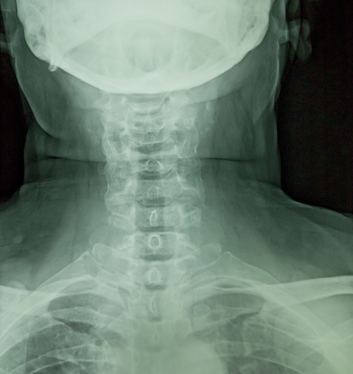 颈肋的表现有感觉障碍,症状会逐渐加重 01 颈肋,主要的病因是什么?