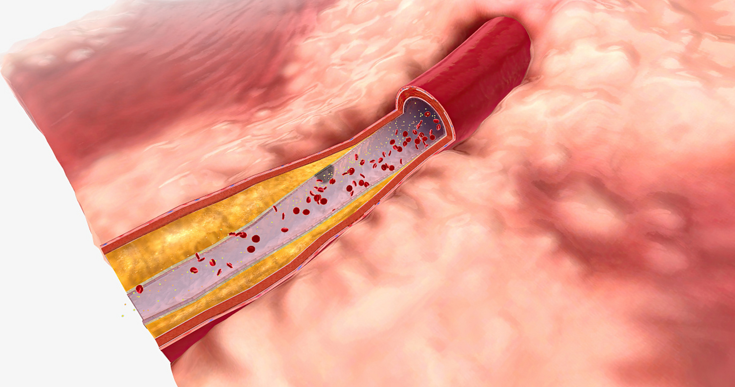 损伤血管的"杀手"——同型半胱氨酸# 同型半胱氨酸是一种氨基酸,说哪