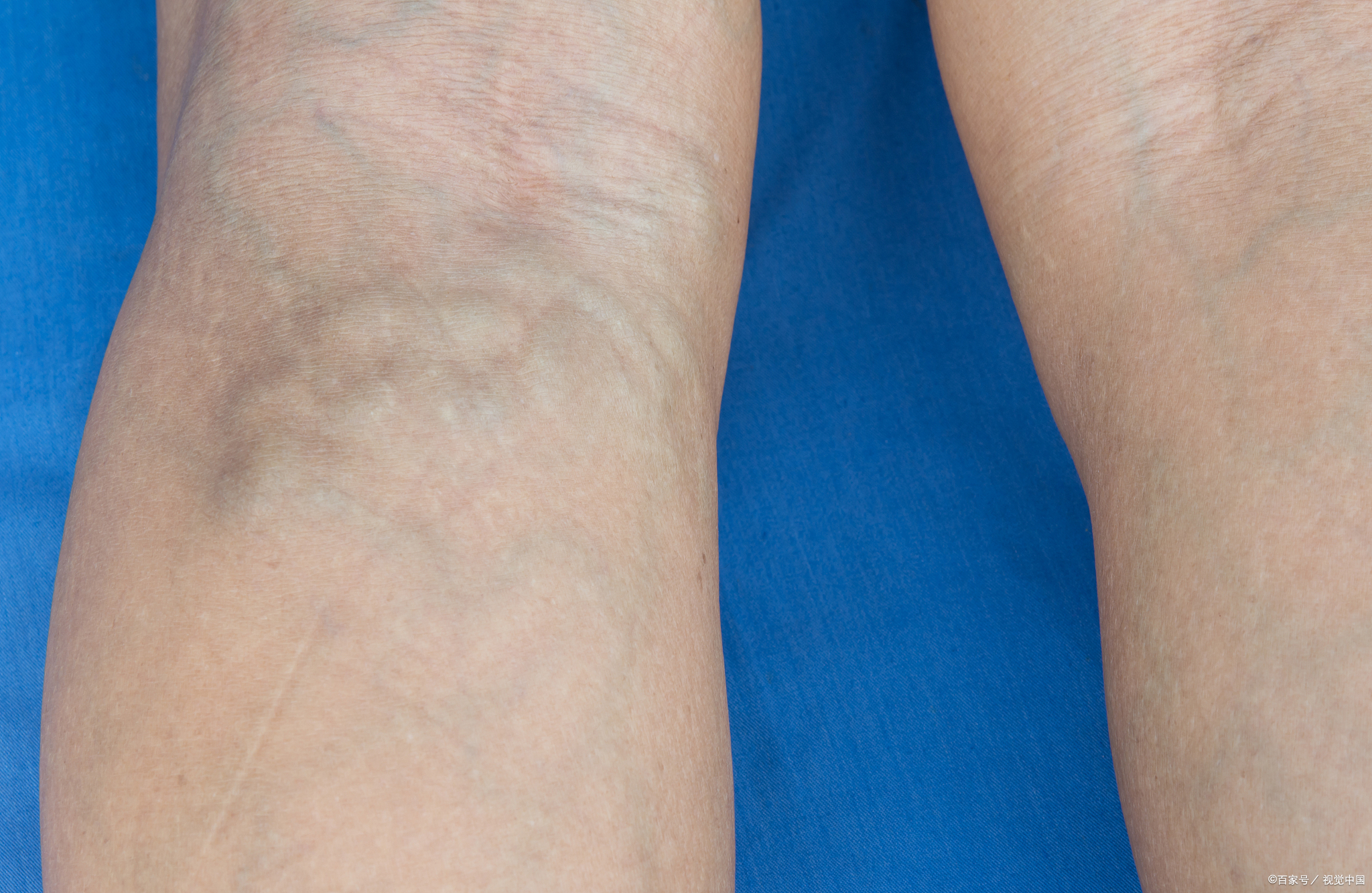 下肢静脉曲张:腿上"青筋凸起",外科干预防并发症