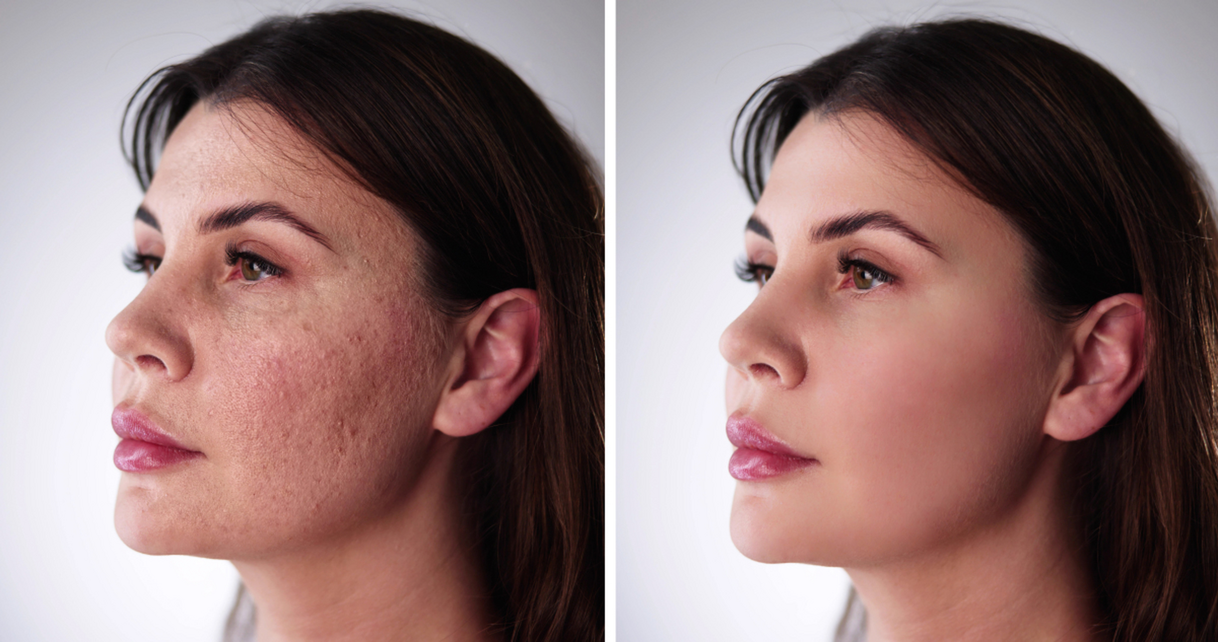 减少嘴唇周围的皱纹:唇部护理的技巧  嘴唇周围的皱纹常常是面部衰老