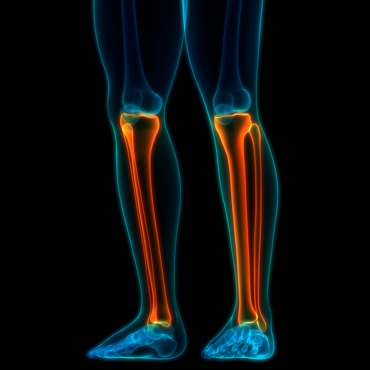 11566胫腓骨骨干骨折多由直