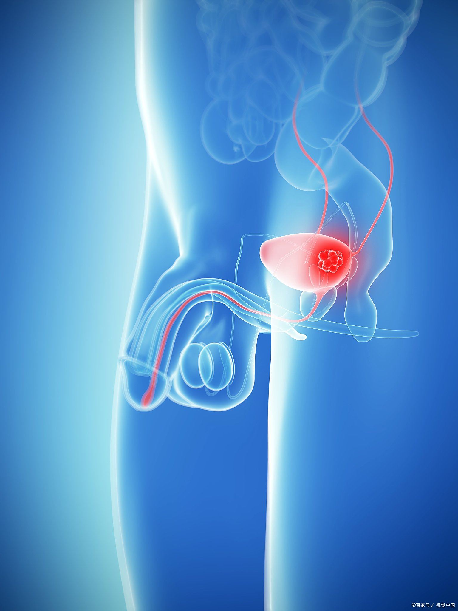 医生告诉你真相 膀胱癌,这个看似遥远的名词,其实离我们并不远