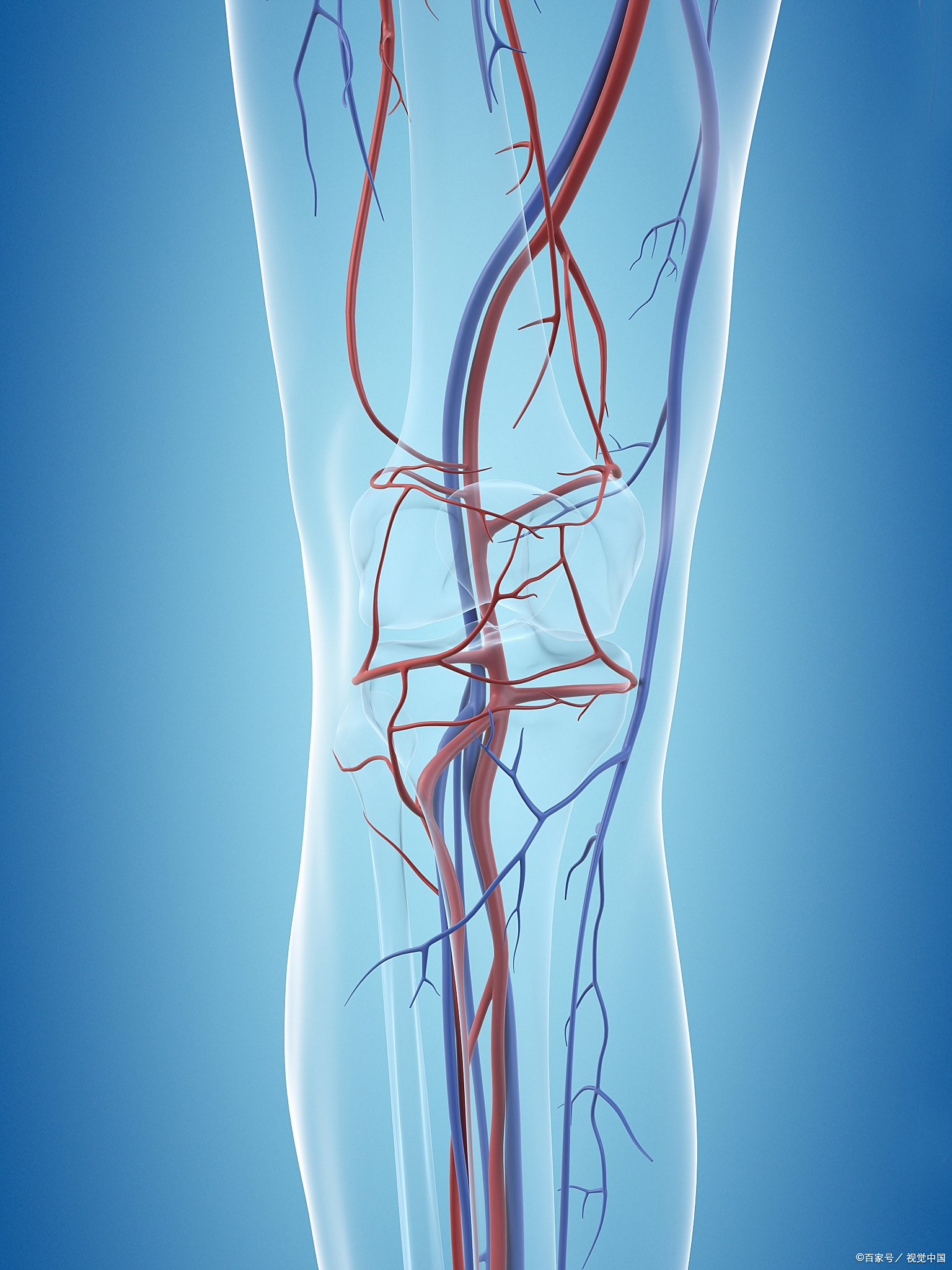 肌间静脉血栓属于下肢深静脉血栓的亚型,通常由血流缓慢,血管损伤或