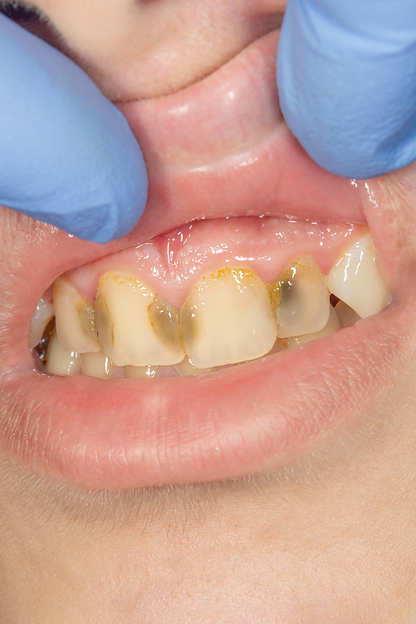 孩子的牙齿钙化是一个重要的生长发育过程,但也可能出现问题.