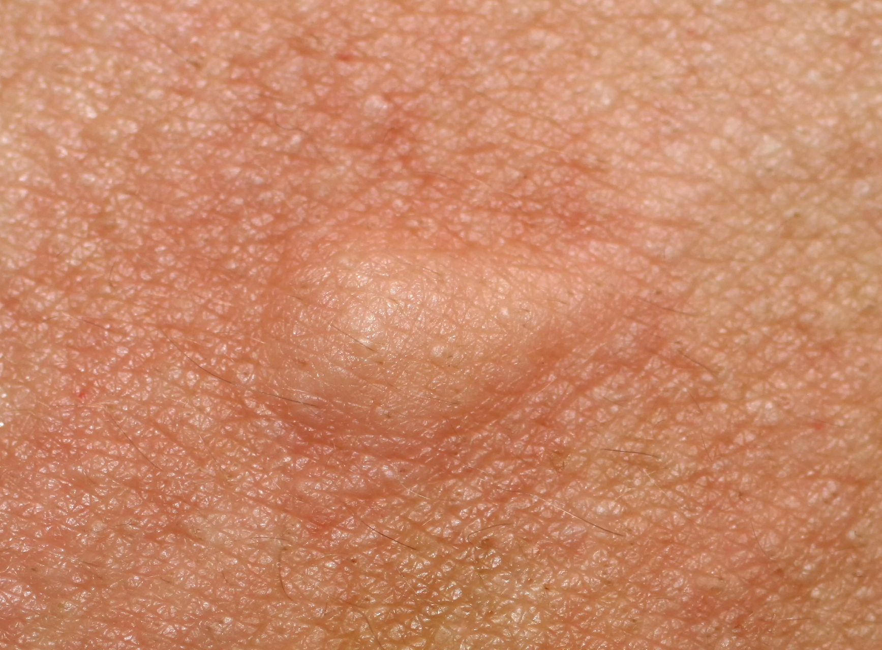 一般来说,皮肤里面长了个硬疙瘩可能是皮脂腺囊肿,毛囊炎,脂肪瘤等