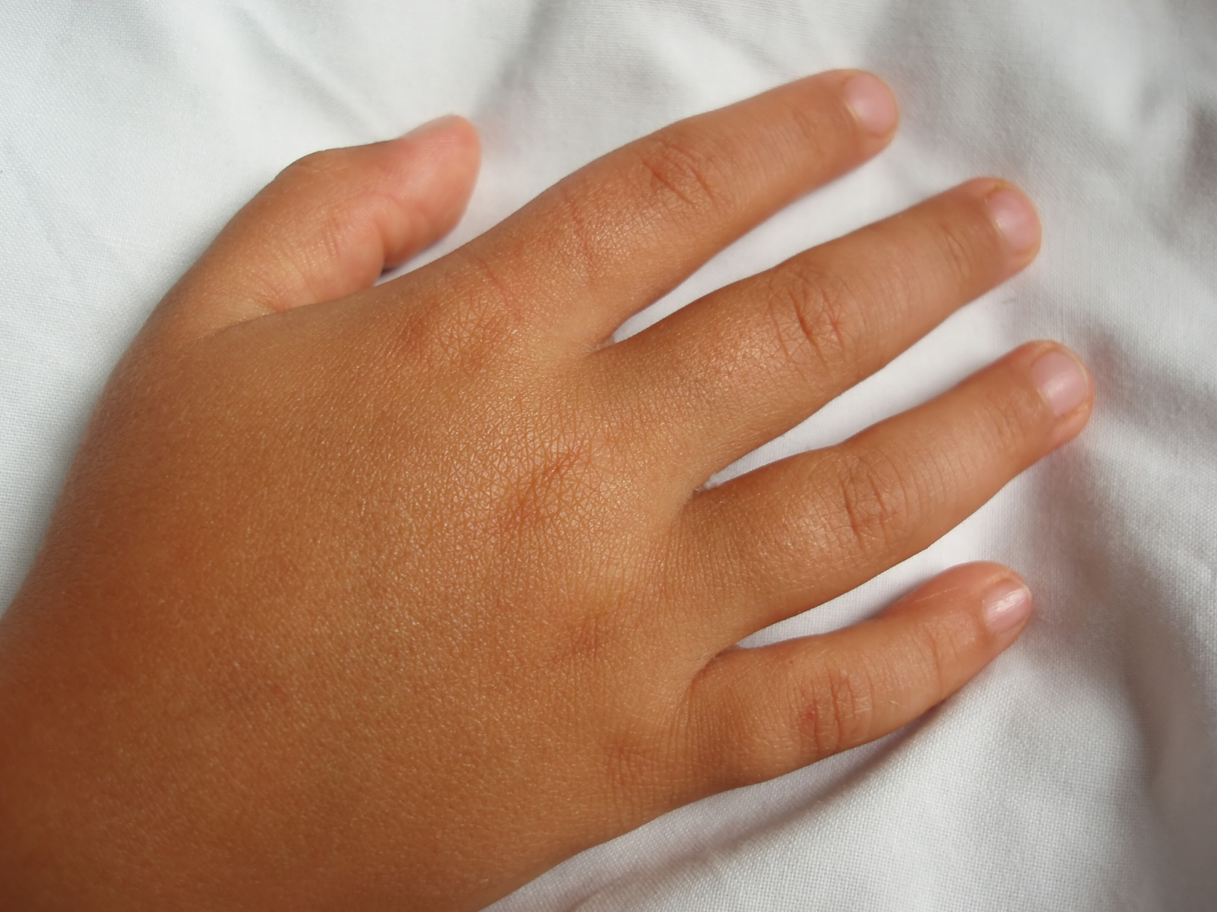 手背水肿可能是短暂的,也可能是长期存在的.