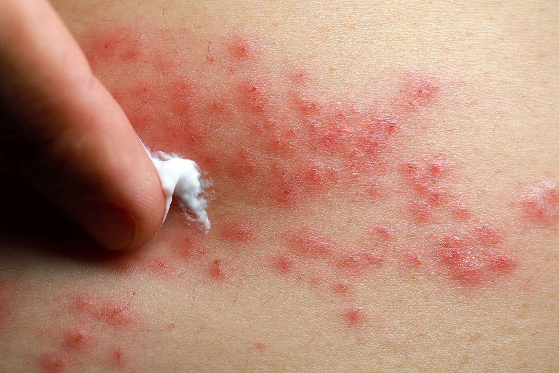 宝宝一直屁股痒,是什么原因?