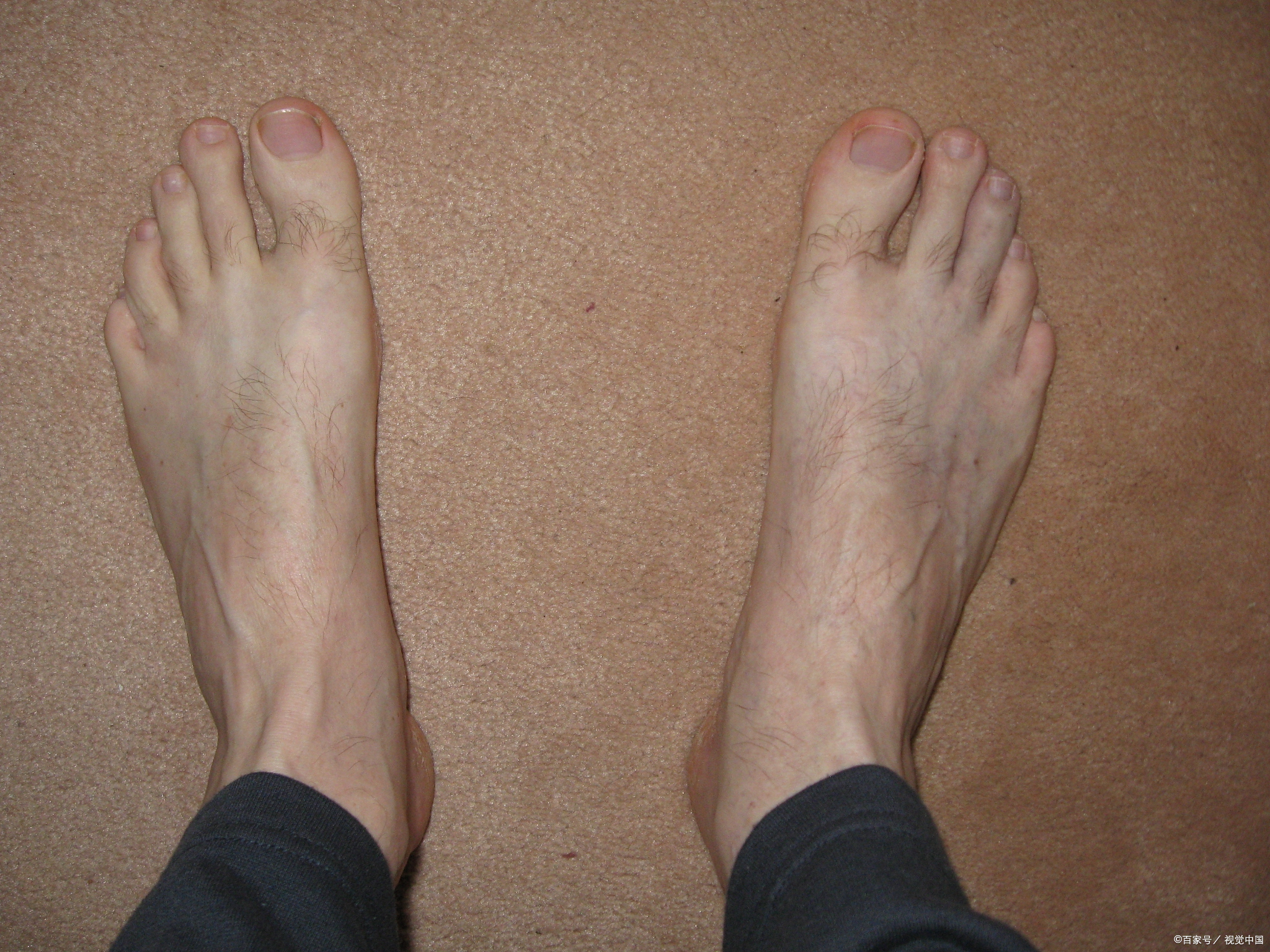 马凡氏综合症脚趾大脚趾外翻马凡综合征脚形状马凡氏综合症症状图片