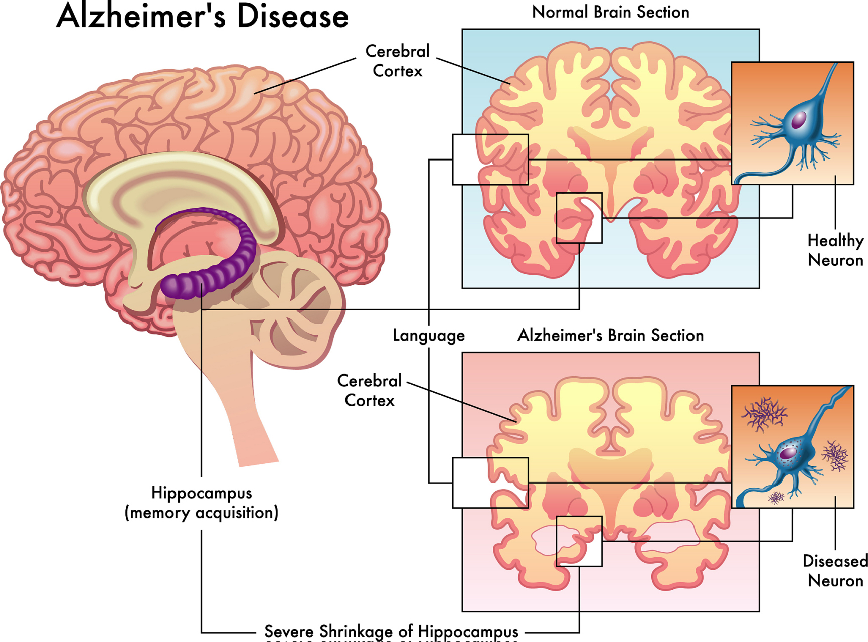 脑白质脱髓鞘改变治疗要针对不同病因进行相应治