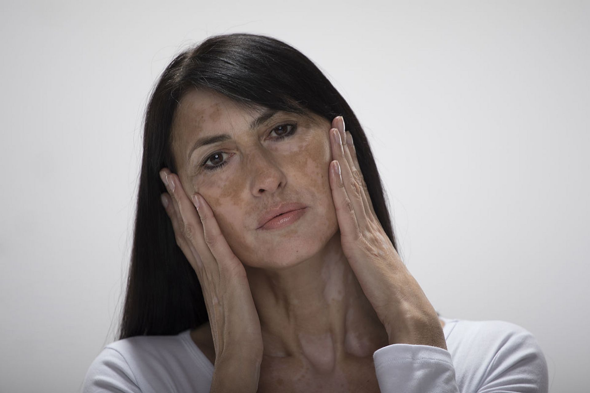 肝病早期症状1:面色暗沉,与晒黑的皮肤不同,面部暗淡无光泽;此外