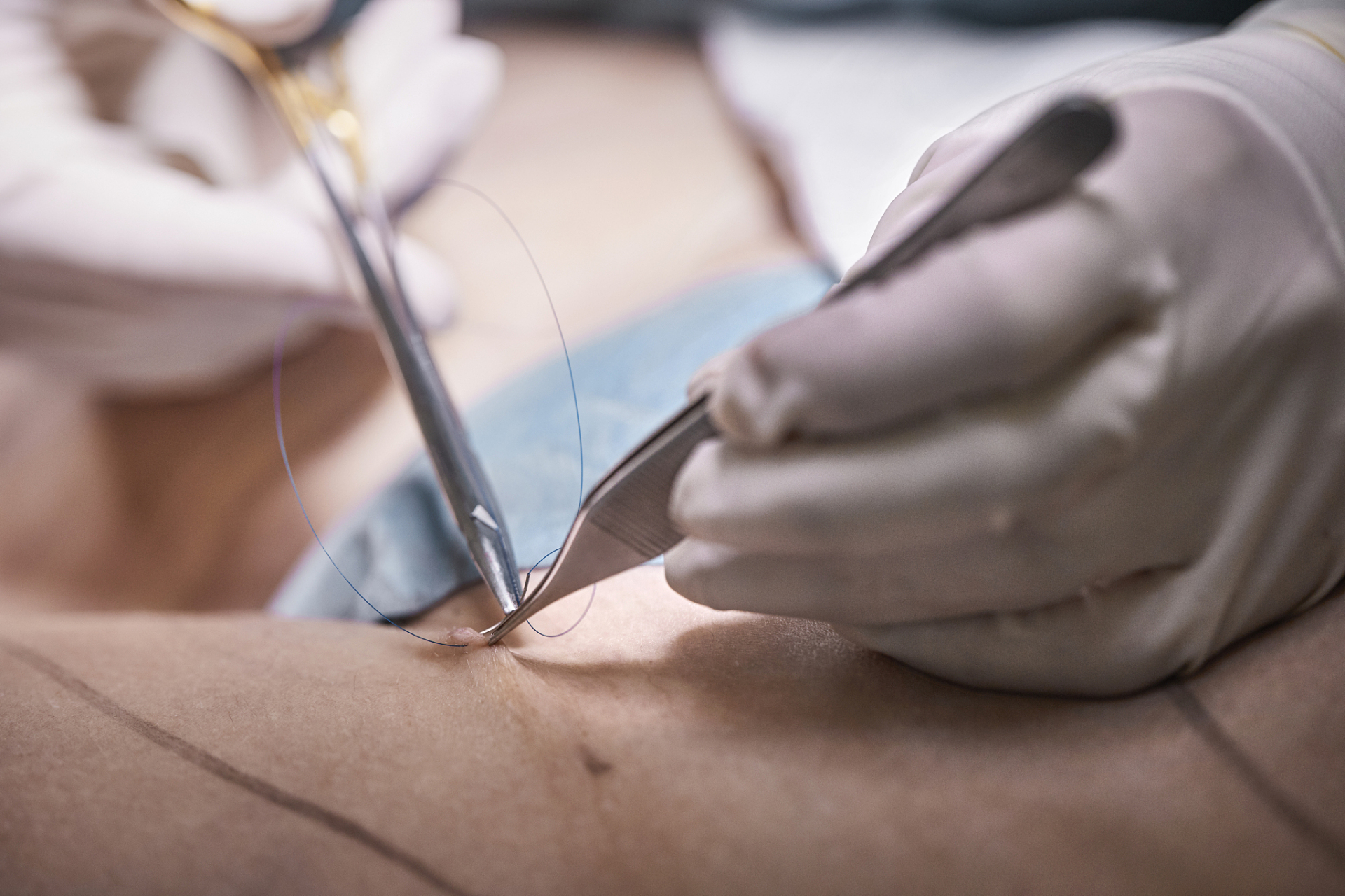 做完缩胸手术时,我们会对切口进行缝合,为了之后疤痕不明显,我们会