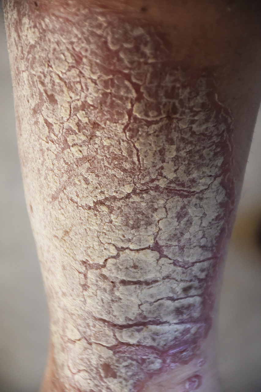 10月份告诉大家一个好办法,治疗牛皮癣在家自己做!