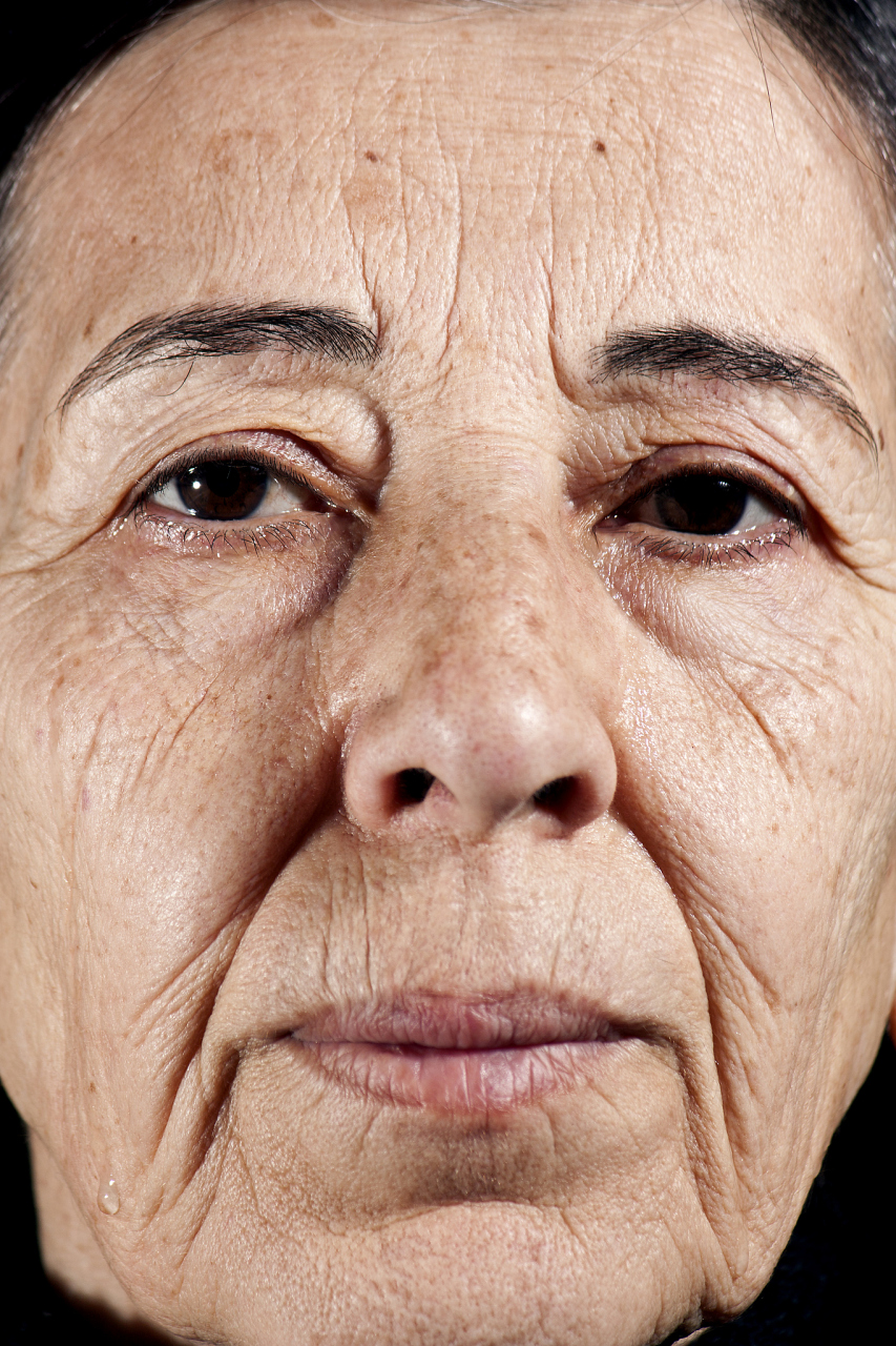 动态纹是由面部肌肉在表情变化时形成的皱纹,通常存在于脸部表情