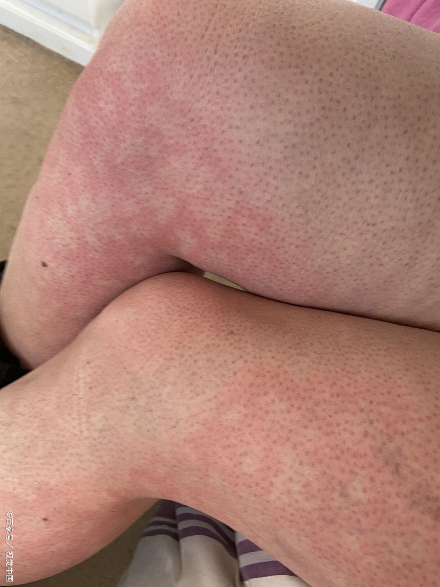 对蜂蜜水过敏的症状图片(要是喝蜂蜜水过敏严重会怎么样) 对蜂蜜水过敏的症状图片(要是喝蜂蜜水过敏严重会怎么样)