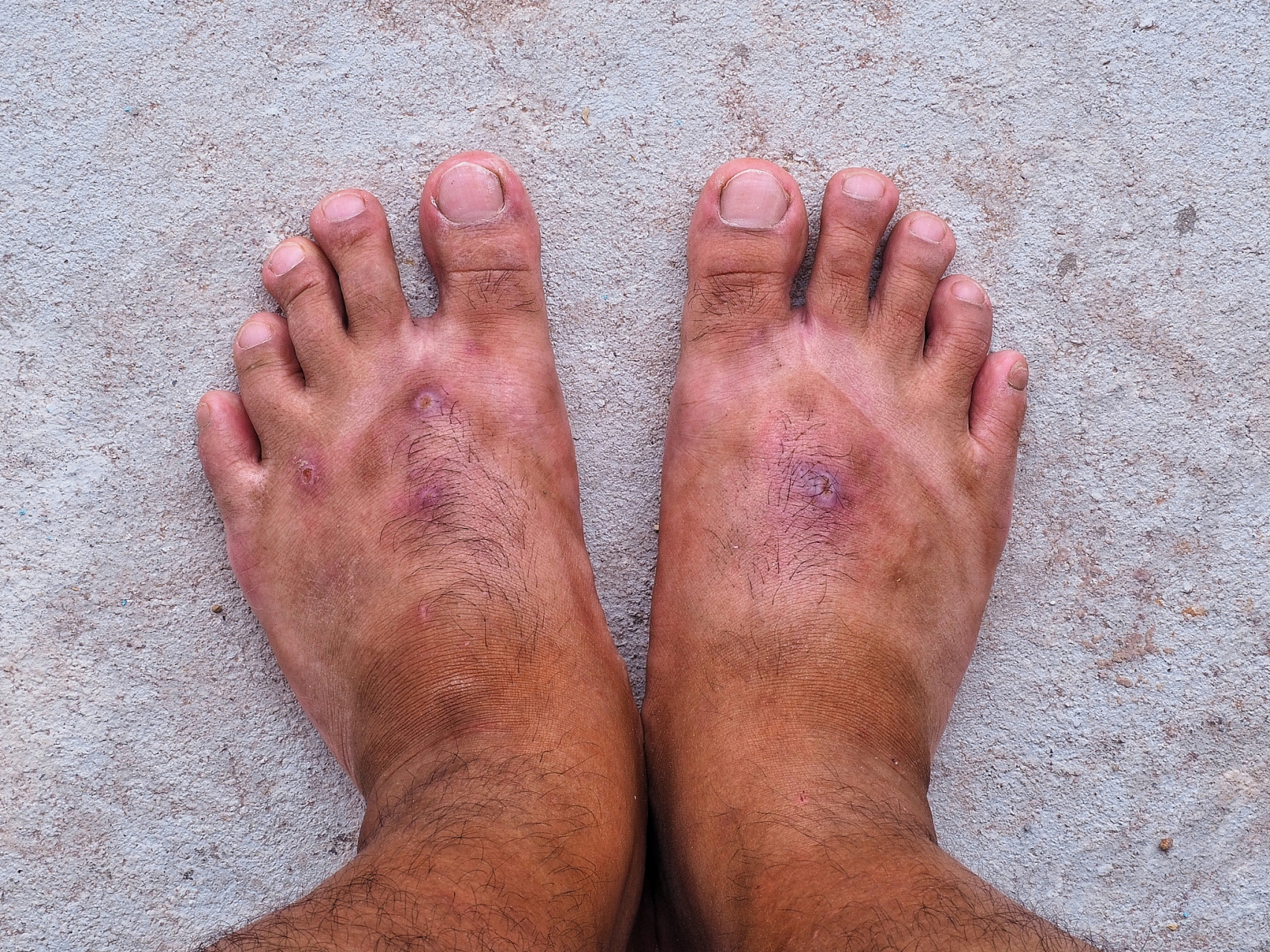 足癣是一种由真菌感染引起的皮肤病,常见于足部,尤其是趾间皮肤.