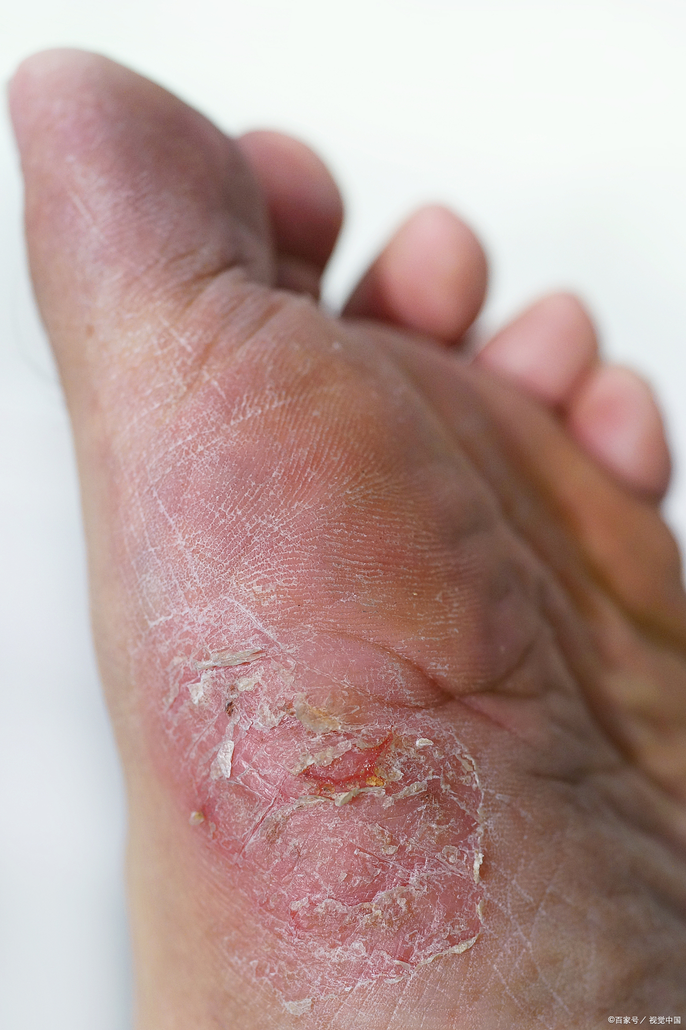 为何冬天还会出现脚气应如何处理?5个妙招学起来,这样才能搞定