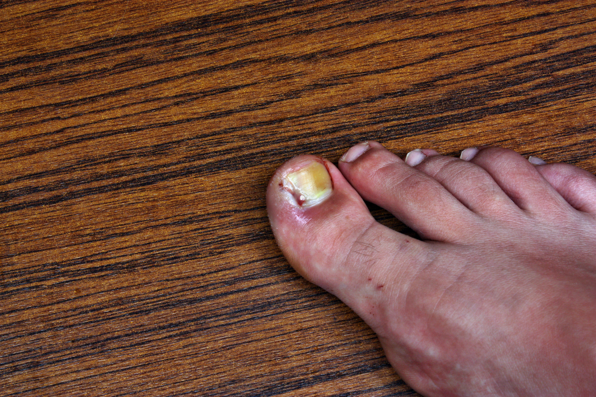 大家习惯于望文生义,听到"灰指甲"几个字,就以为是灰色或黑的,其实不