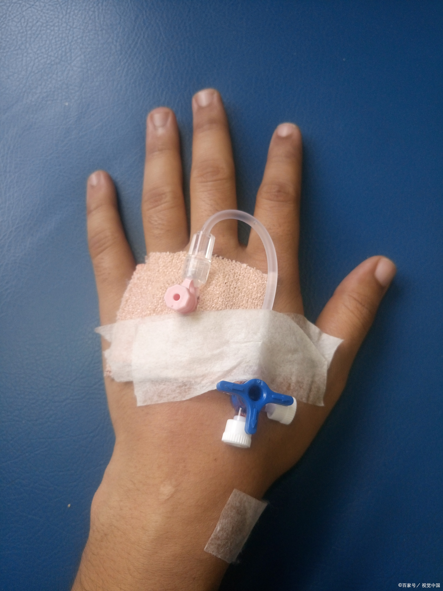 打吊针手肿了怎么消肿