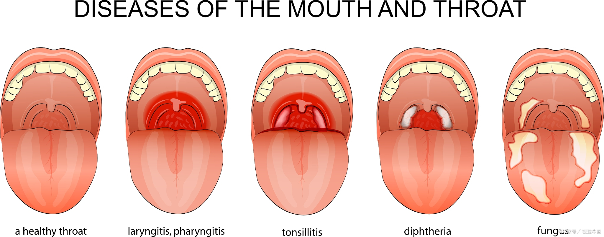 认识小儿咽炎疾病带来的危害
