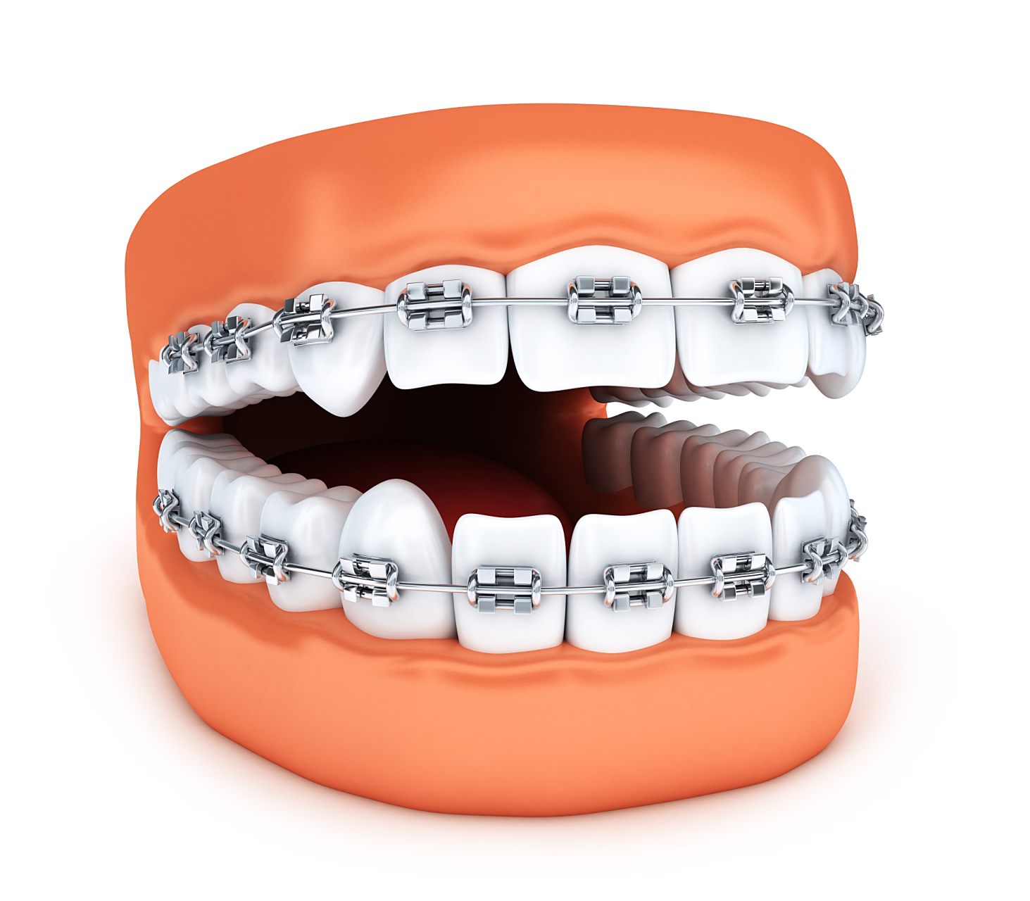 牙齿矫正术后的护理要怎么进行	 牙齿矫正术后的护理