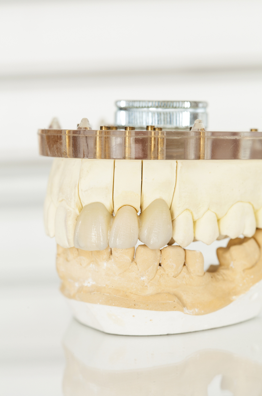 烤瓷牙牙龈发黑怎么办?