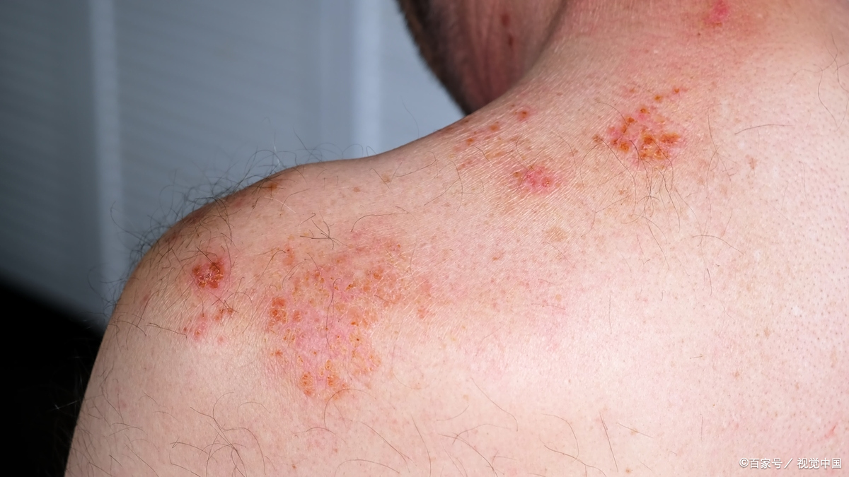手足口病疱疹病毒手足口病好了要不要去医院疱疹外国人祝疱疹怎么