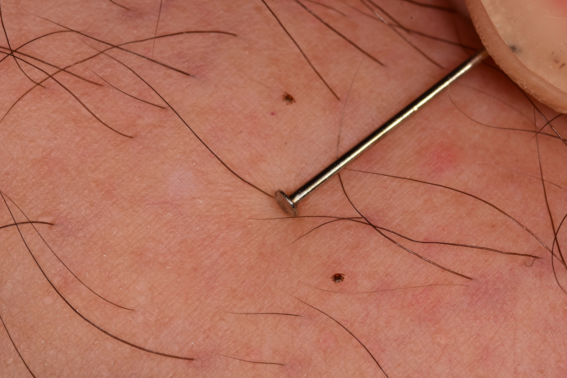 皮脂腺异位症一般是皮脂腺发育的生理性变异和皮脂腺增生所导致.