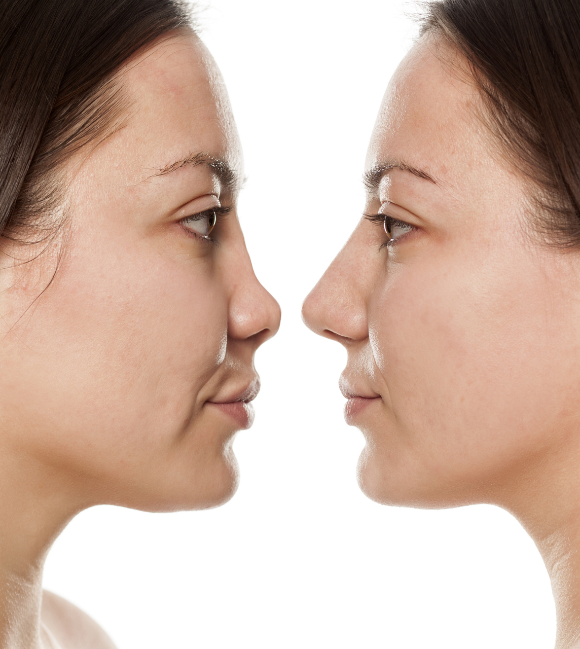 鼻子的发育其实是终身的,大多数人小时候鼻子都是发育的不太完整的