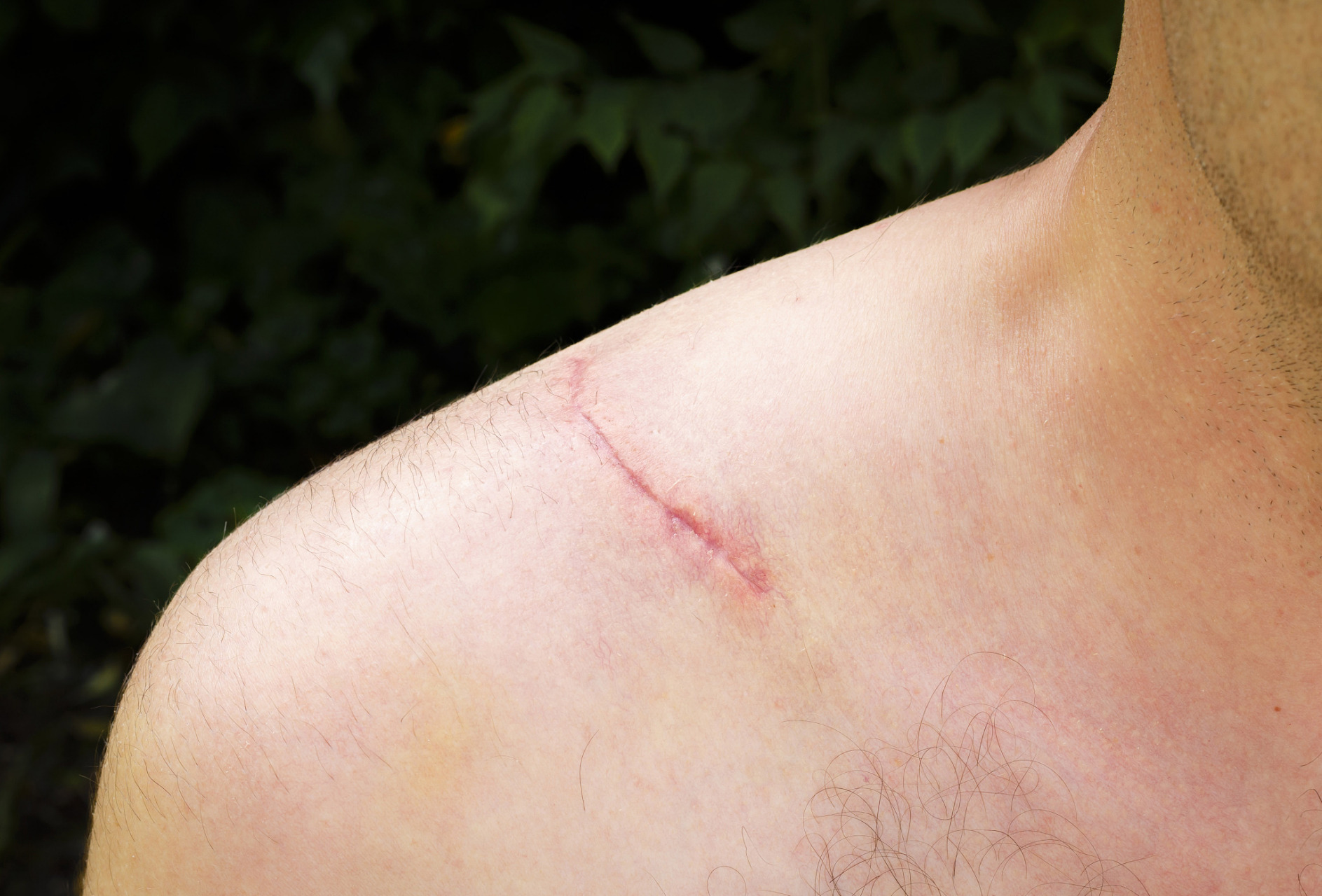 新款透气医用胶带#  伤口增生,也叫肉芽肿,是一种在创伤或手术部纬い