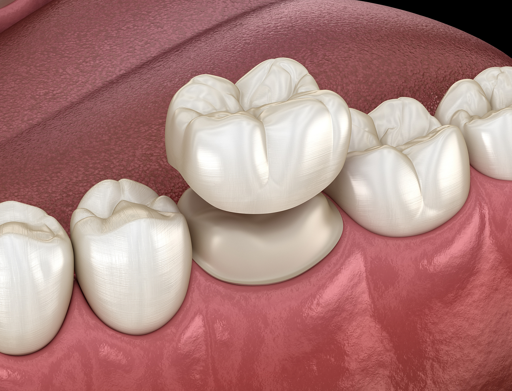 尤院长告诉你:烤瓷牙虽美,但维护不当,牙套下的牙齿确有可能"烂掉"