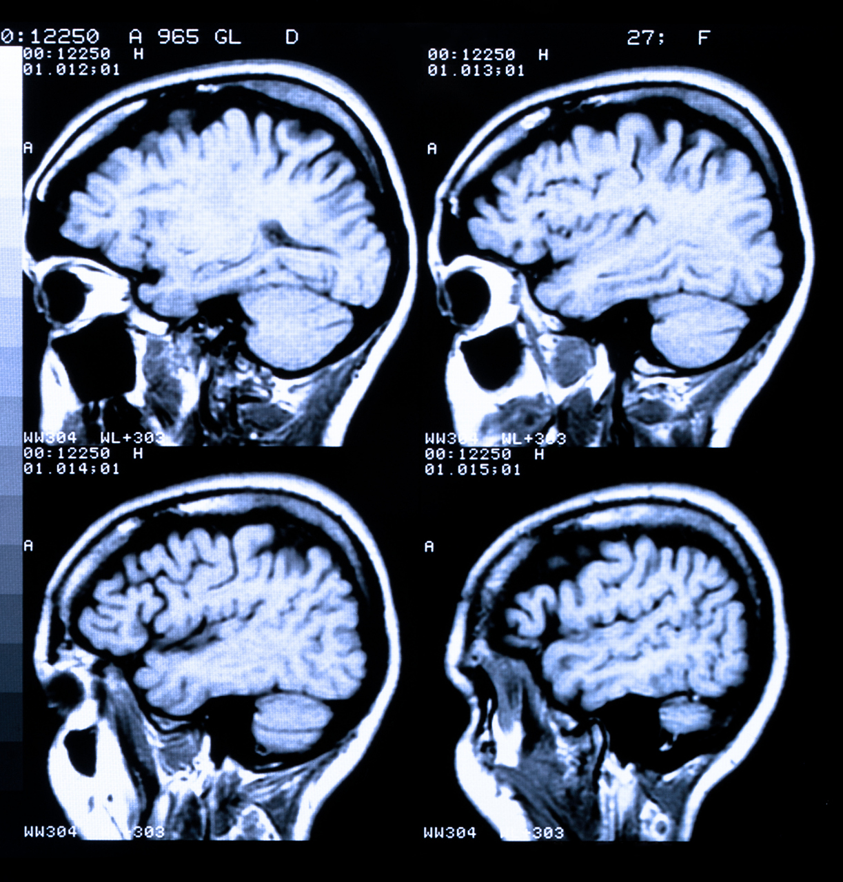 小脑萎缩# #益脑健步汤治疗小脑萎缩共济失调#  小脑萎缩又称脊髓小