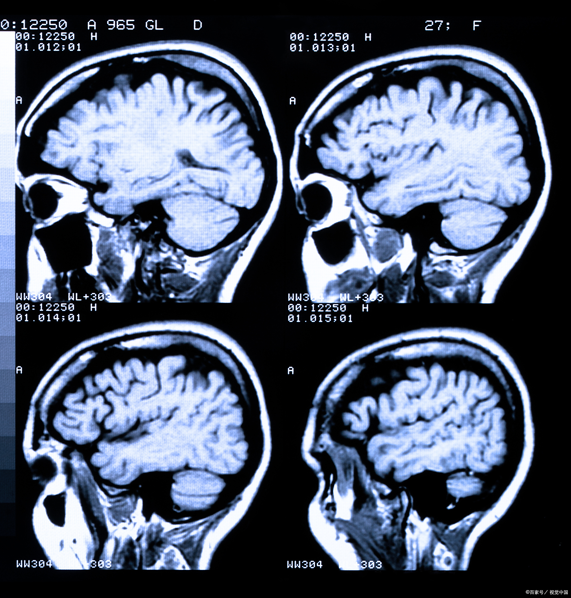 公公脑干出血,老公指责我,我到底做错了什么