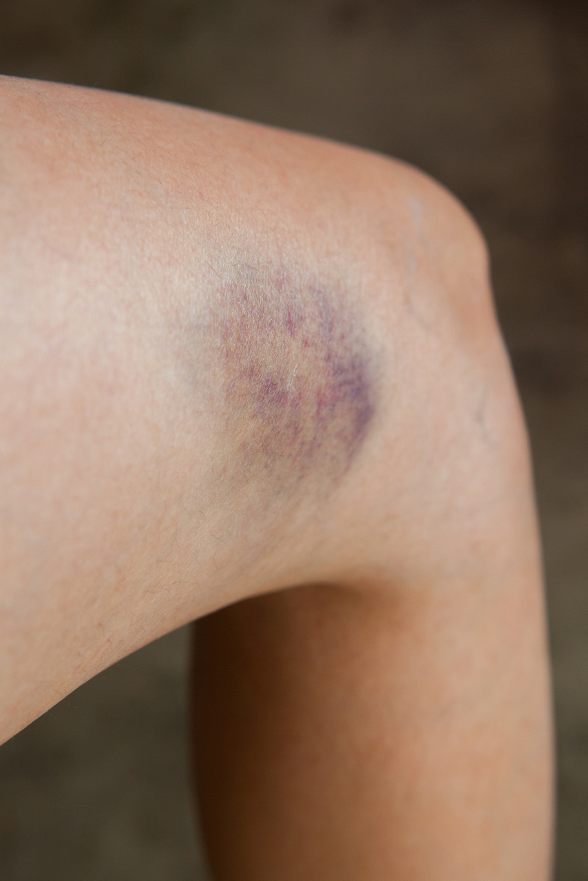 腿被电瓶车撞肿二十多天了还没好没外伤?