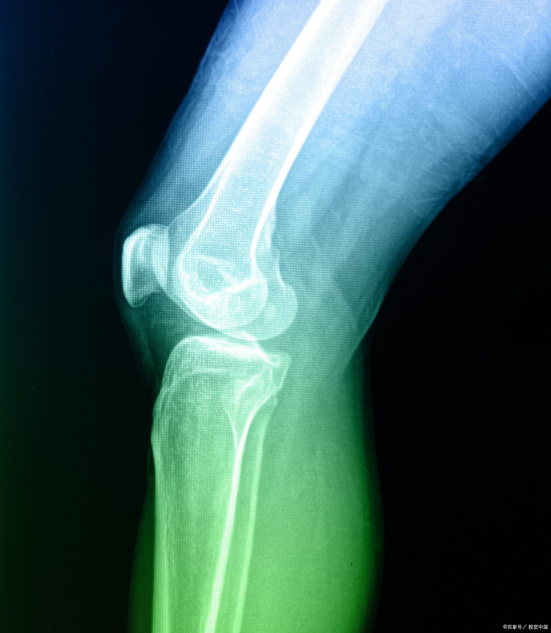 膝关节脱位并韧带损伤,是运动损伤中较为严重的类