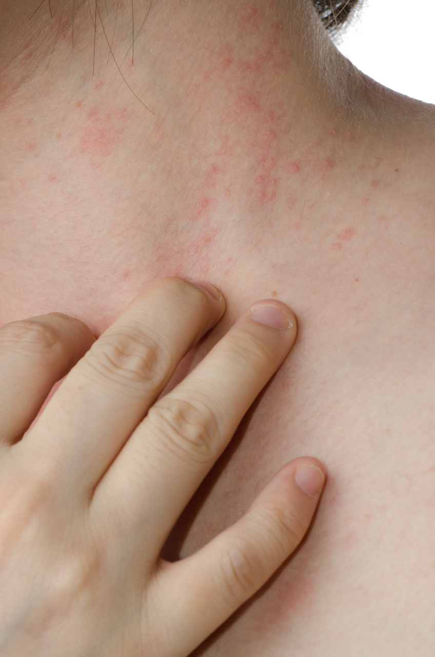 听说有女生闻到小龙虾气味就过敏到全身发红,这简直比吃辣椒还刺激啊!