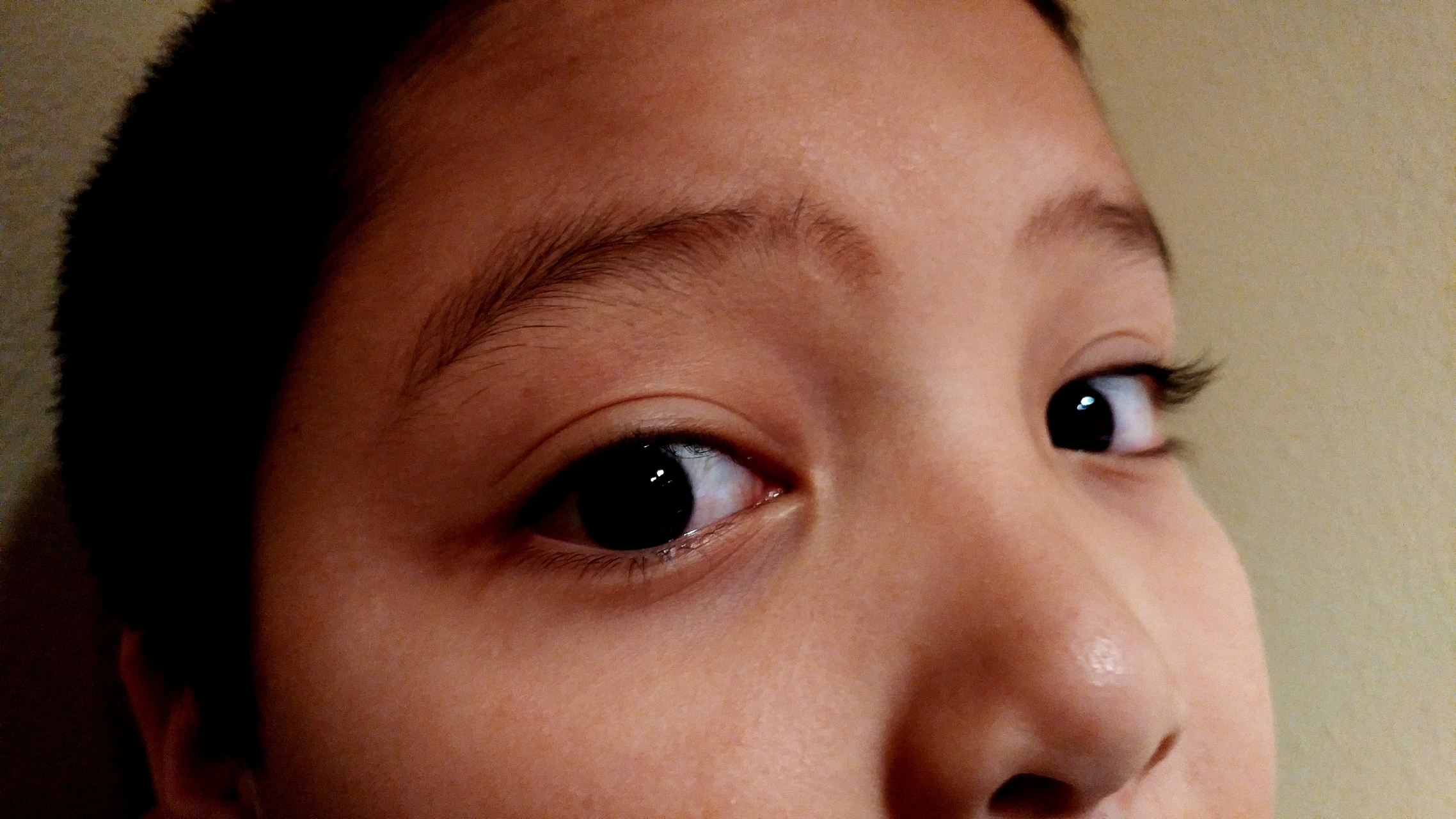 【患者自述】:我是一位因为高度近视而眼球突出的患者,我的眼睛不仅