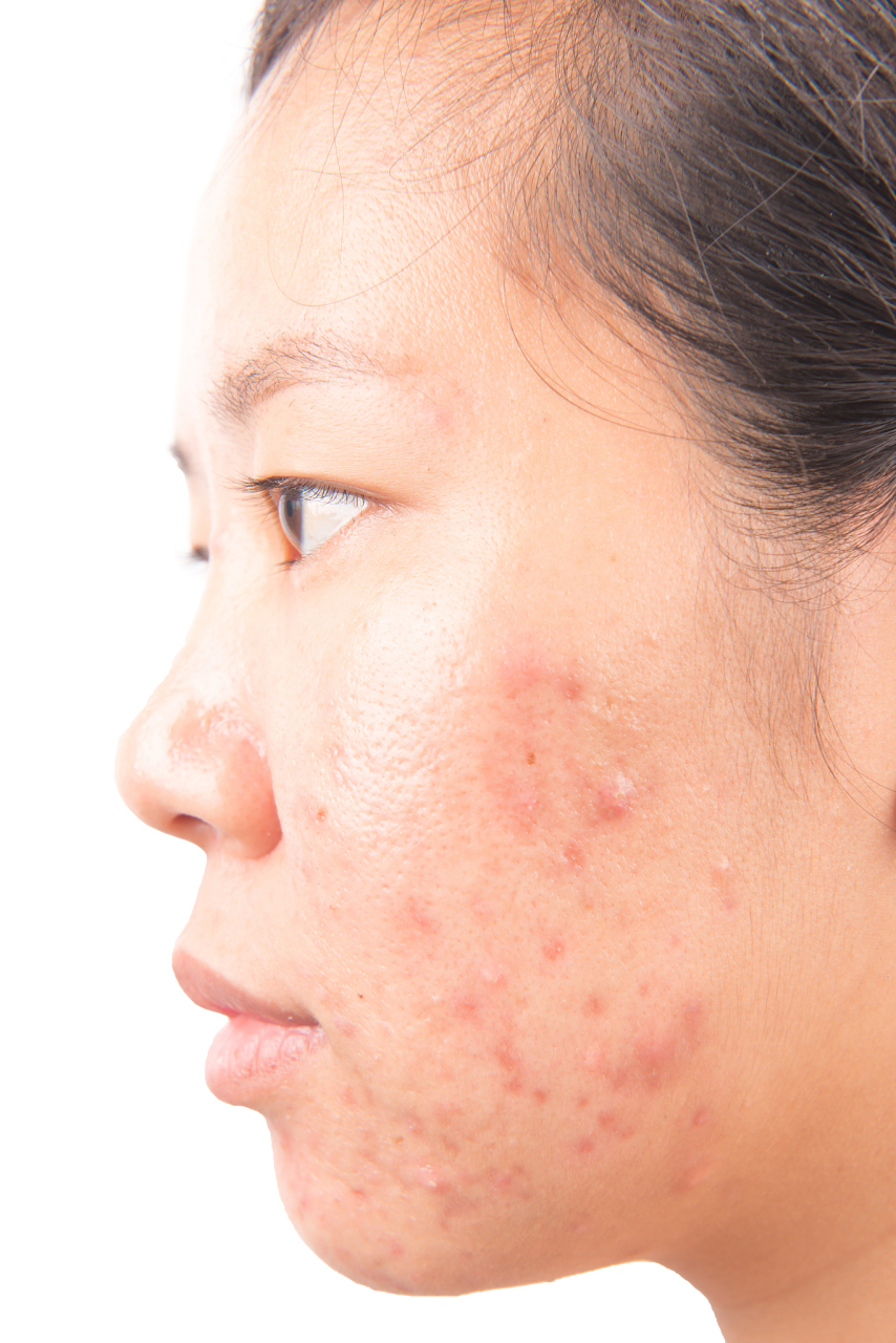 脸上有扁平疣如何去除  扁平疣是一种常见的皮肤病,通常是由人类乳头