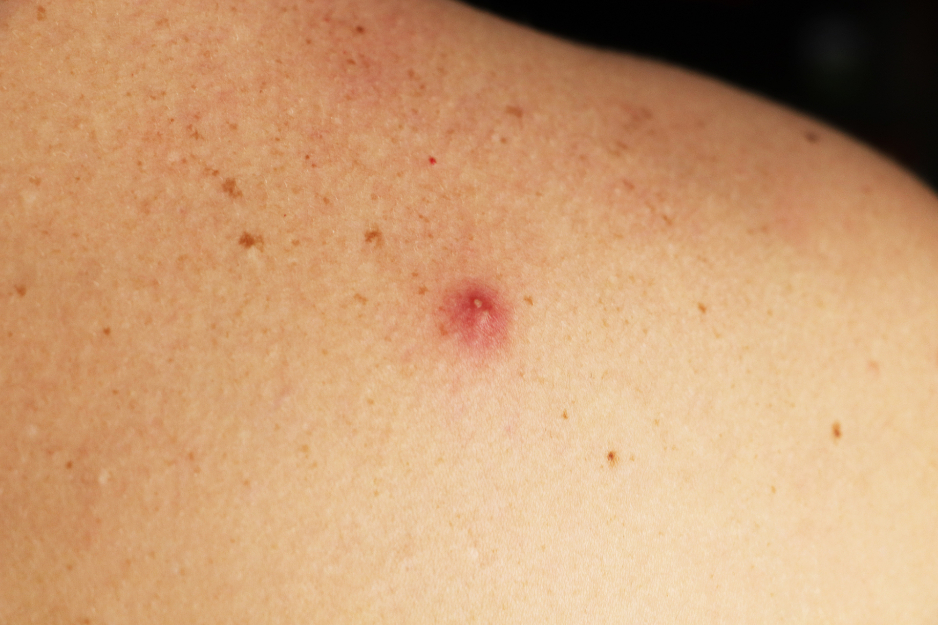 小红点可能是由多种原因引起的,包括但不限于皮肤炎症,过敏反应,血管